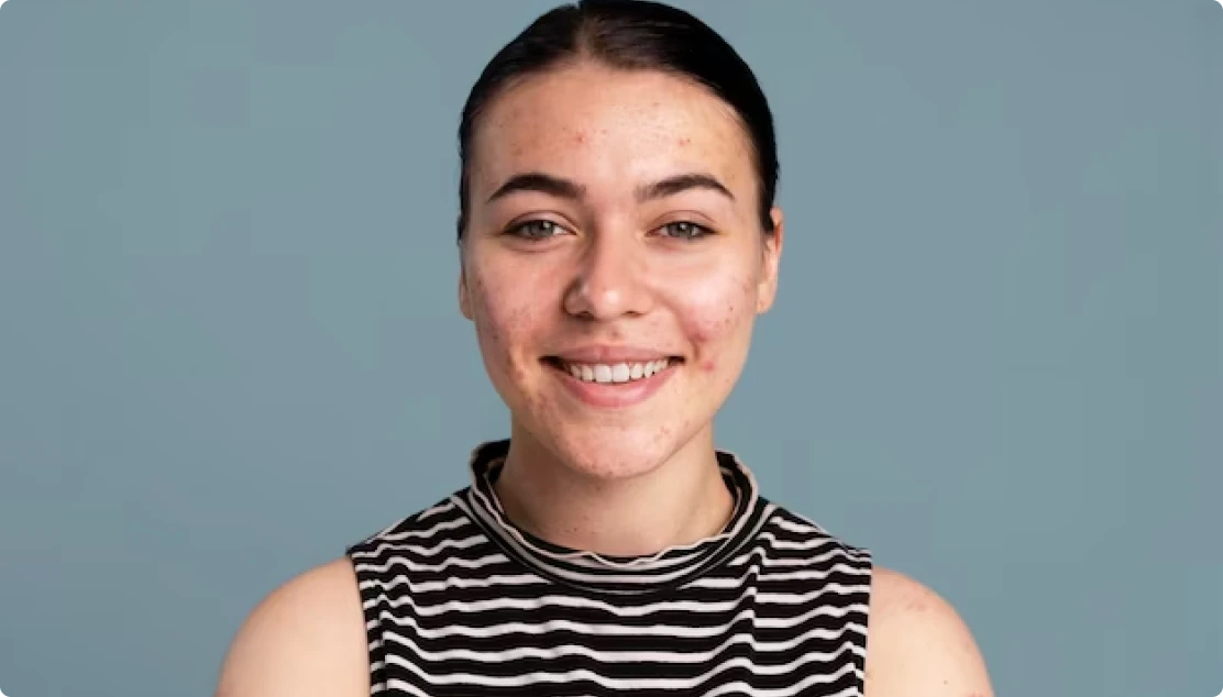 Advanced Acne Scar Removal in Chennai Sky Skin and Laser Clinic