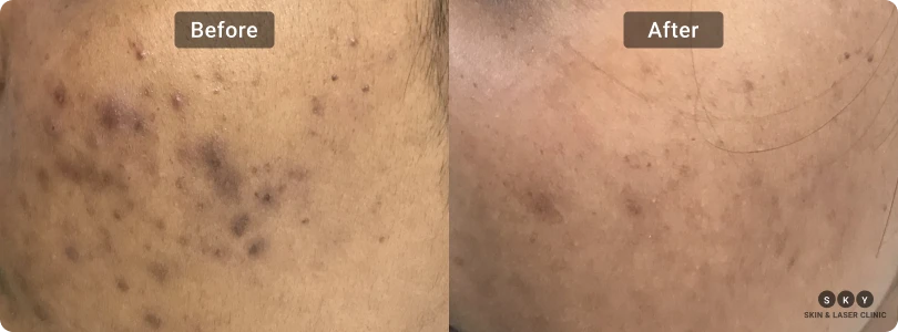 Acne Scar Treatment3