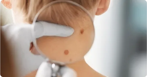 Mole_Removal_with_Laser_Treatment