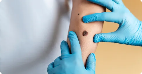 wart_removal_near_me