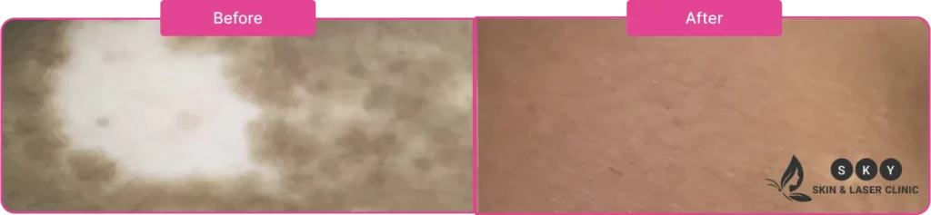 Before & After Vitiligo Treatment