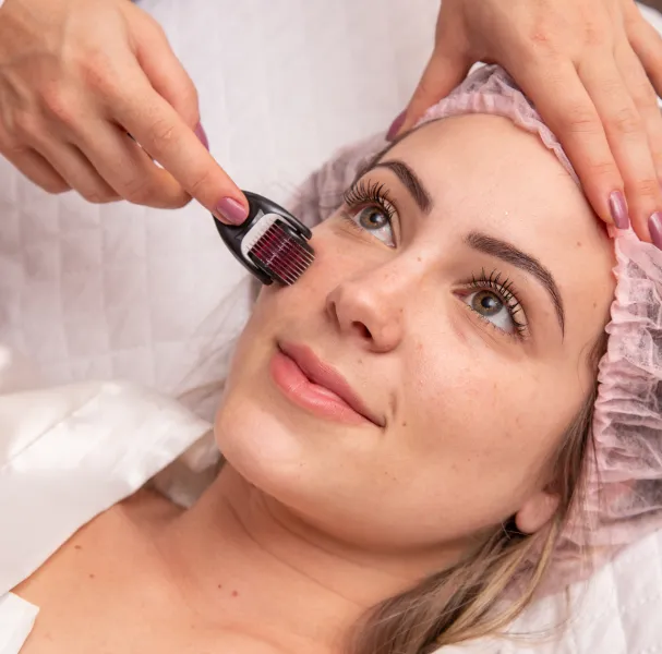 Best Derma Roller Treatment in Chennai at Sky Skin and Laser Clinic