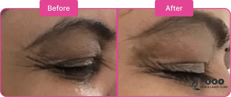 Botox_Treatment_in_Chennai