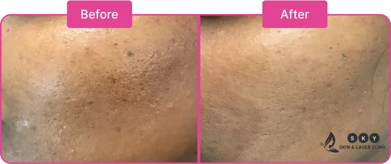 Chemical_Peel_Treatment_in_Chennai