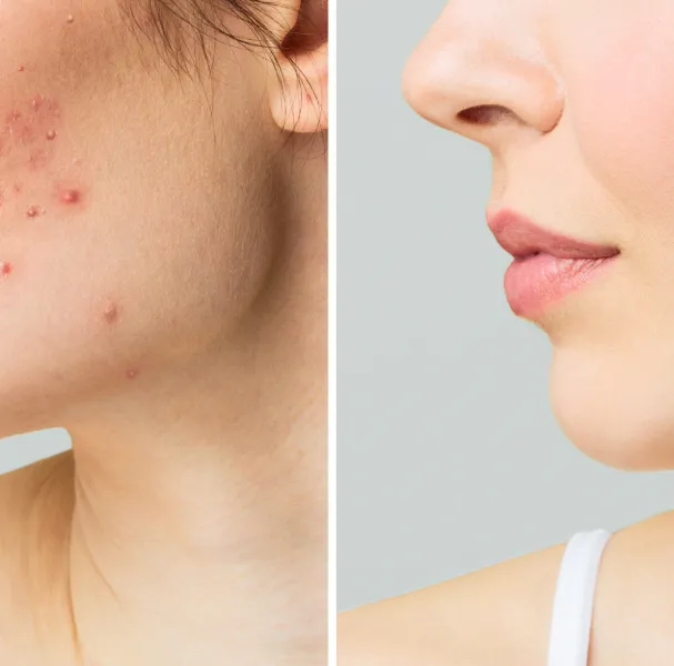 Clearer Skin Starts Here – DPN Removal Results You Can See