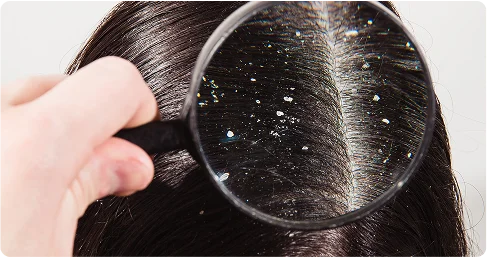 Dandruff_Treatment_in_Chennai