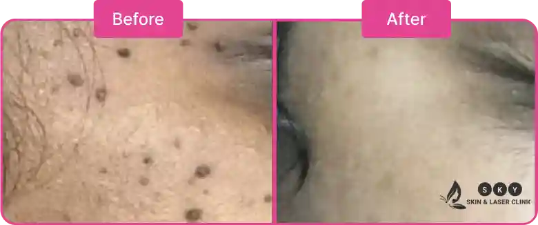 Before_and_After_for_DPN Removal_in_Chennai