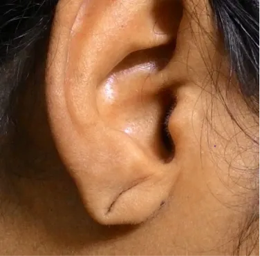 Earlobe-Repair-Image