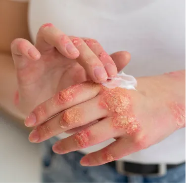 Eczema-Dermatitis