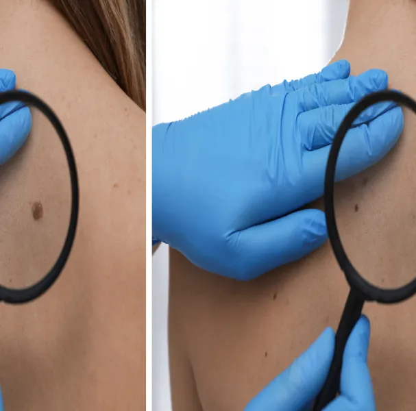 Epidermoid Cyst Removal Pictures and Results Banner Image