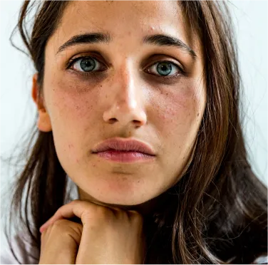 Freckles & Lentigines