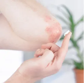 Fungal-Infections-Image