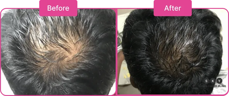 Hair_Loss_Treatment_in_Chennai