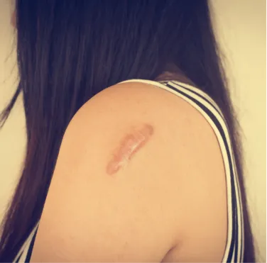 Keloid Treatment