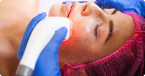 Acne & Scar Removal Treatment Chennai