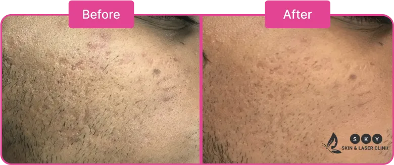 Acne_Treatment_in_Chennai