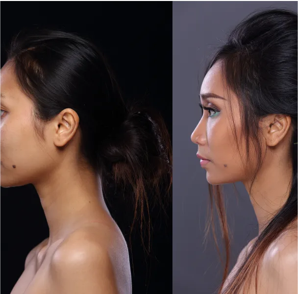 Mole Removal Before & After – Real Results, Clearer Skin Banner Image