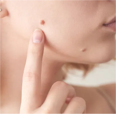 Moles