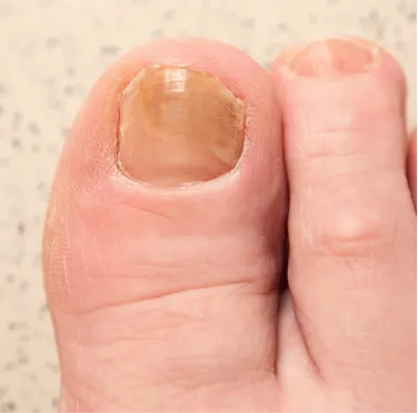 Nail-Infections-Disorders
