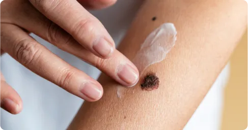 Facial_wart_removal_treatment_in_Chennai