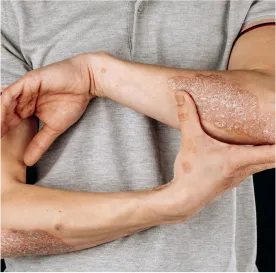 Psoriasis Treatment