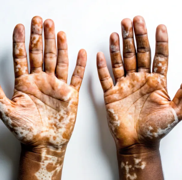 Real Results Vitiligo Treatment Before & After Photos