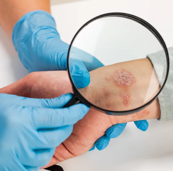 Ringworm Treatment – Before & After Results That Speak for Themselves