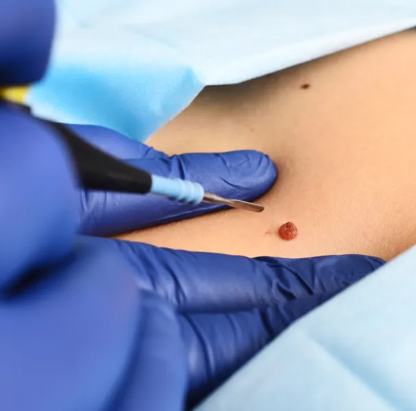 Best_Mole_Removal_Treatment_in_Chennai