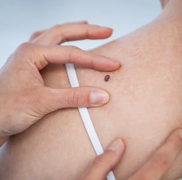 Say Goodbye to Skin Tags with Our Skin Tags Removal Treatment