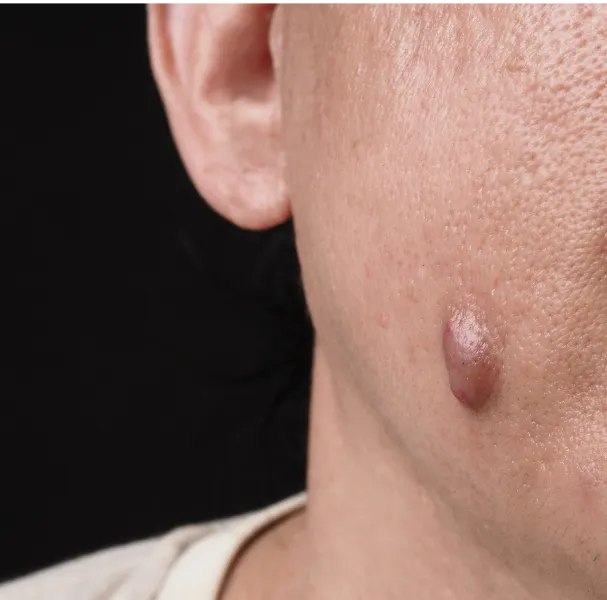 Seborrheic Keratosis Removal Treatment Images See the Transformation