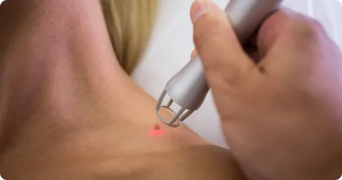 Laser_Mole_Removal