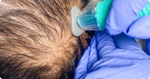 Acne & Scar Removal Treatment Chennai