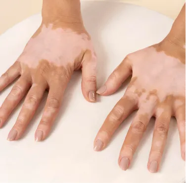 Treatment of Vitiligo