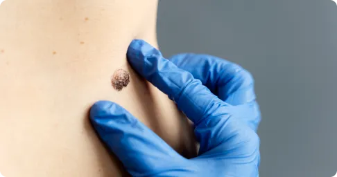 laser_treatment_for_warts