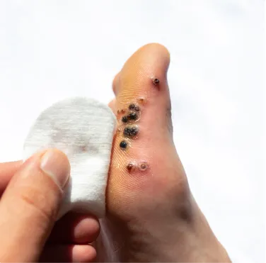 Warts