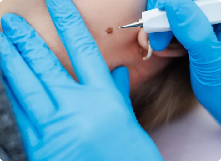 What is Epidermoid Cyst Removal Images