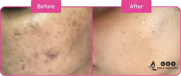 Before_and_After_for_Pimple_Scar_Removal