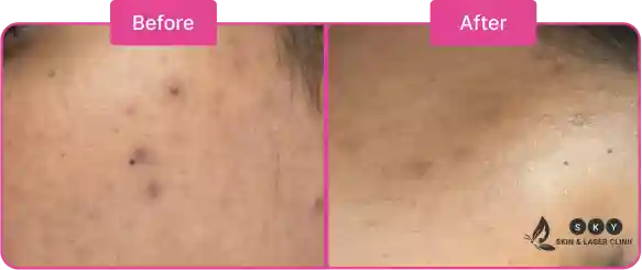 Before_and_After_for_Pimple_Scar_Treatment