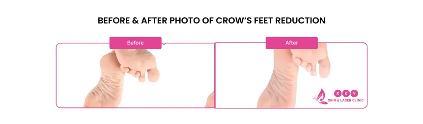 before_after_botox_wrinkles