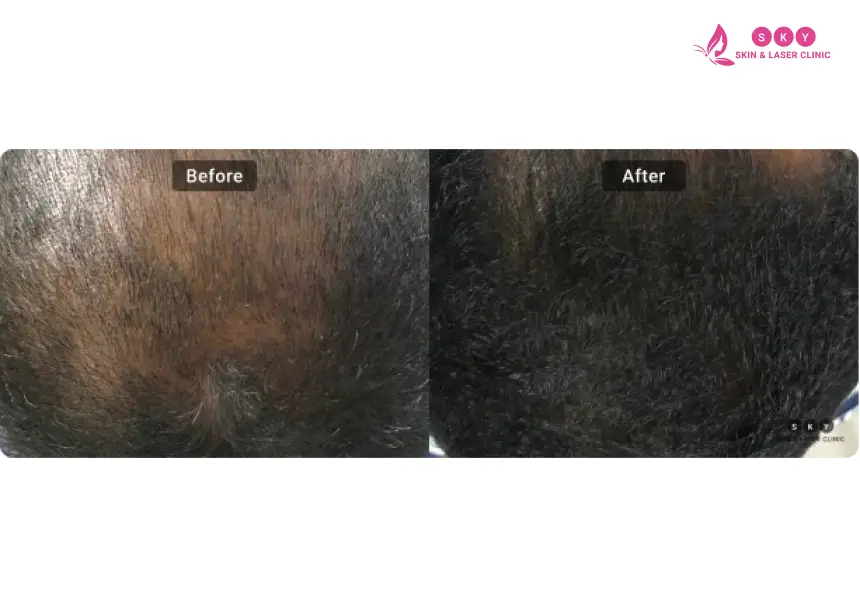 before_and_after_result_of_hair_fall_treatment