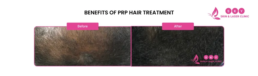 benefits_of_PRP_hair