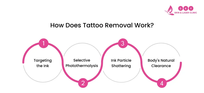 how_does_tattoo_removal_work