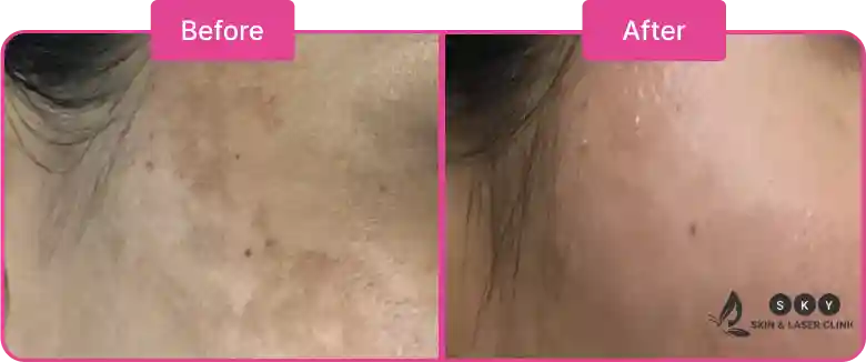 melasma_images