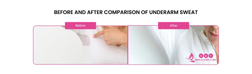 pros_and_cons_of_underarm_botox