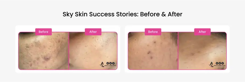 sky_skin_success_stories
