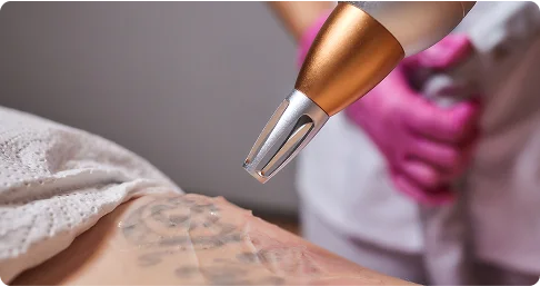 Permanent_Tattoo_Removal_in_Chennai