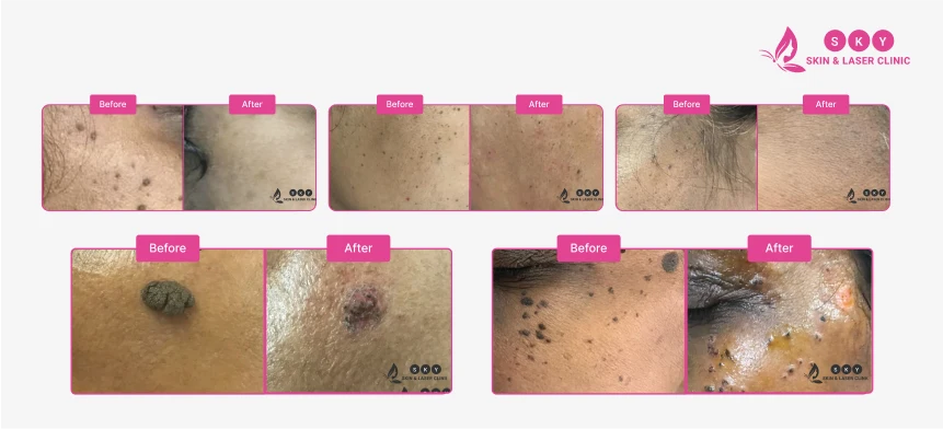 Before_and_After_for_Best_Female_Skin_Specialist_in_Chennai