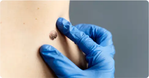 Best_wart_and_Mole_Removal_Treatment_in_Chennai