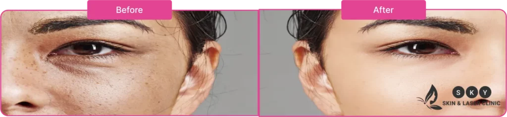 BEFORE_AFTER_LASER_TONING