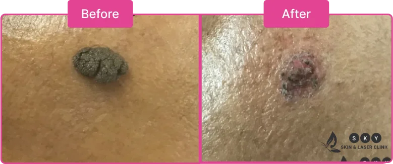 Before_and_After_for_DPN_Treatment
